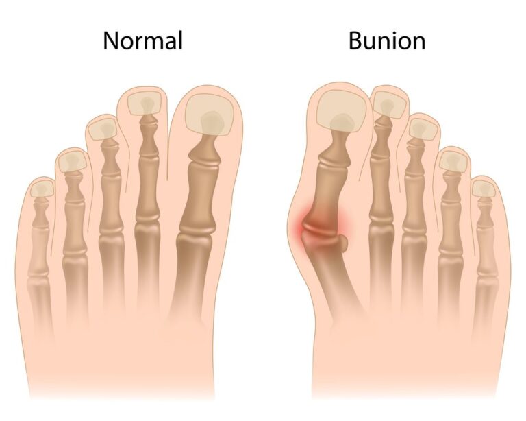 Bunion Surgery FAQs Get "Heeled" at Hadfield Foot and Ankle Dr
